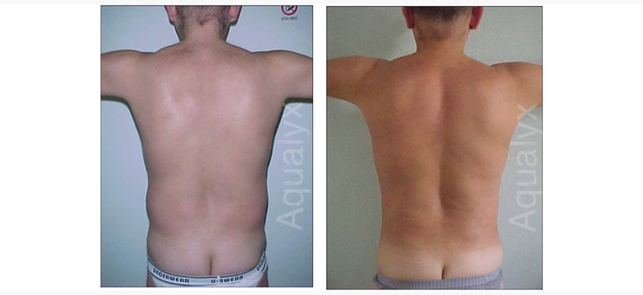 Aqualyx-flanks-Before-and-After