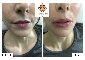 Lips-Before-After-1