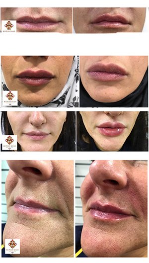 lip fillers - before and after