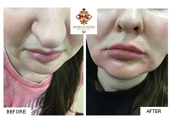 Lips-Before-After