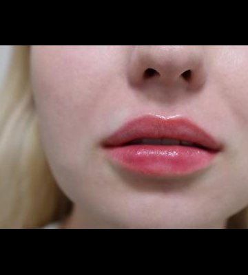 Lip Fillers and Injectables in London