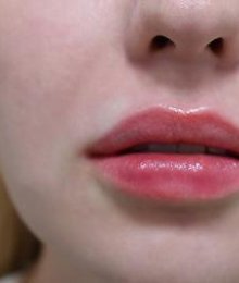 Lip Fillers and Injectables in London
